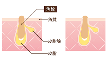 角栓の原因