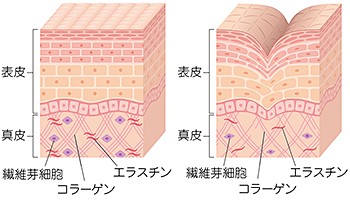 たるみができる原因